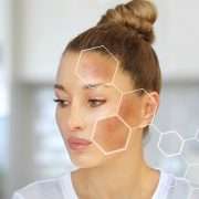 How To Reduce And Prevent Hyperpigmentation