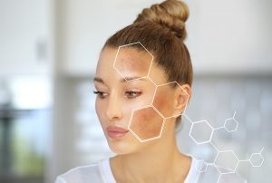 How To Reduce And Prevent Hyperpigmentation?