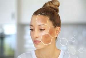 How To Reduce And Prevent Hyperpigmentation