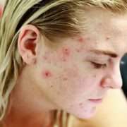 Ways to heal acne scars faster 1