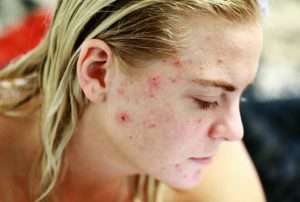 Ways to heal acne scars faster 1