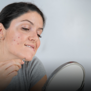 Blog 6 D14 The Underlying Reason Behind Acne Hirsutism