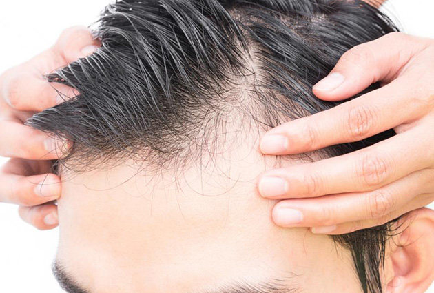 5 Simple Ways To Stop Hair Fall For Men - Plixlife