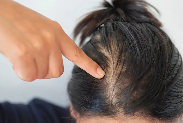 How long does it take for hair to grow back after hair loss? - hairmd