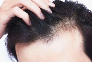 The Best Hair Loss Treatment for Men – Top 5 Options