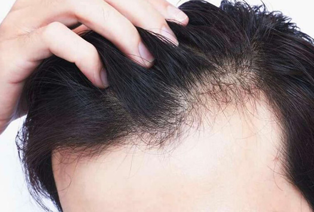 The Best Hair Loss Treatment For Men - Top 5 Options