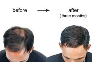 Male Pattern Baldness Treatment – Top 7 Solutions That Actually Work