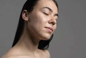 How To Choose A Good Acne Remedy That Will Actually Help You Get Rid Of Acne