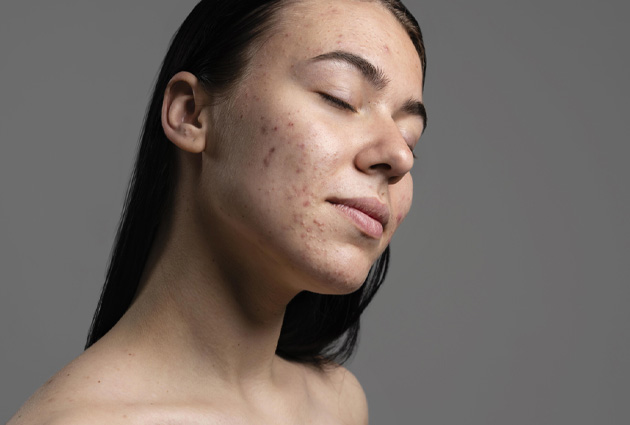 Blog 31 How To Choose A Good Acne Remedy That Will Actually Help You Get Rid Of Acne