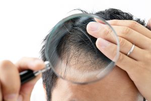 The Guide to Understanding Male Hair Loss and How to Prevent It