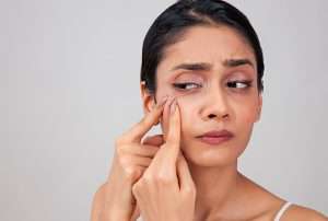 Blog 33. Say Goodbye to Acne Marks with These Effective Tips