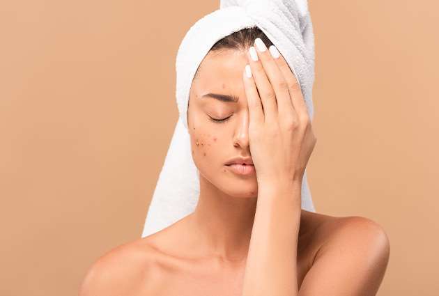 Blog no. 32 How To Get Rid Of Acne Scars Marks Use This Best Serum For Acne