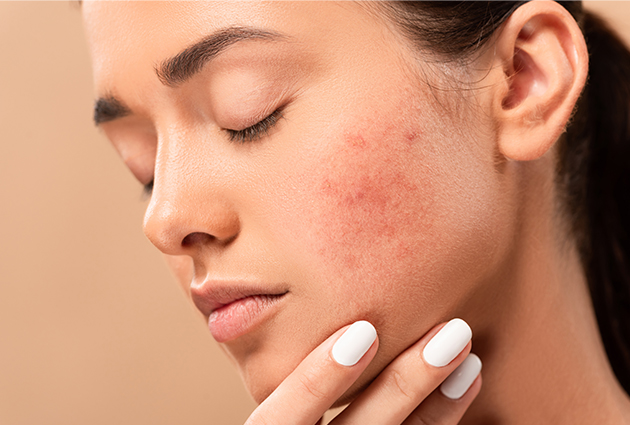19. How To Pick The Perfect Serum For Acne Prone Skin 10 Evidence Backed Tips