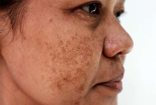 Melasma 