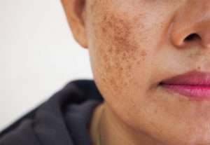 24. Blemishes on face Types Causes Remedies