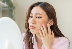 Ultimate  Guide to Prevent Face Dark Spots