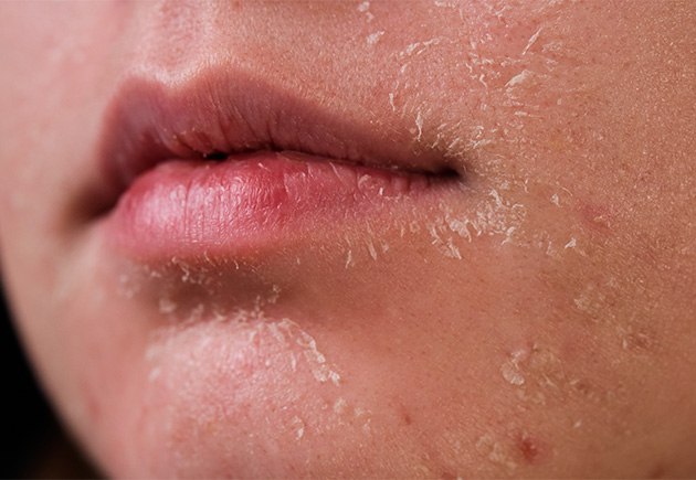 Peeling Skin on Face