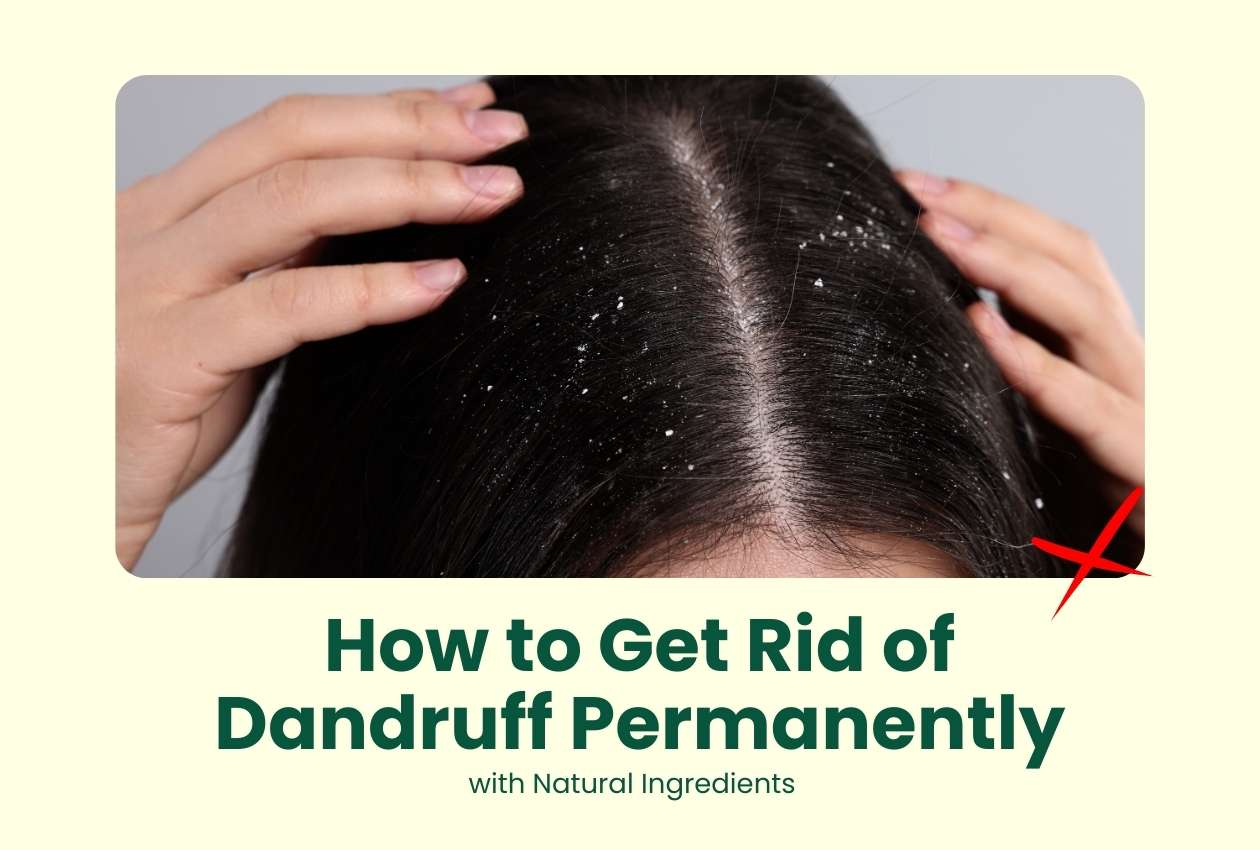 How to Get Rid of Dandruff Permanently